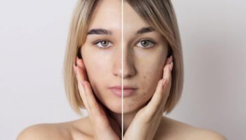 before-after-blackhead